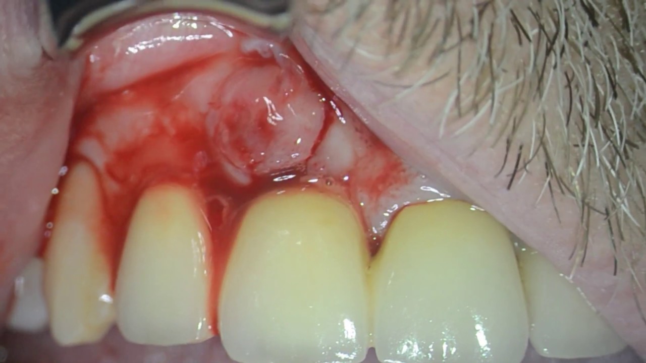 Amoxicilline dent prix