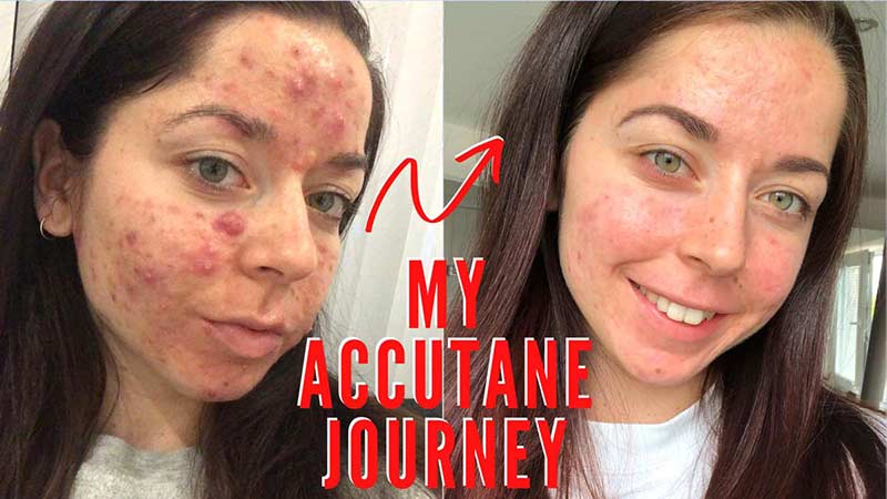 coût du accutane