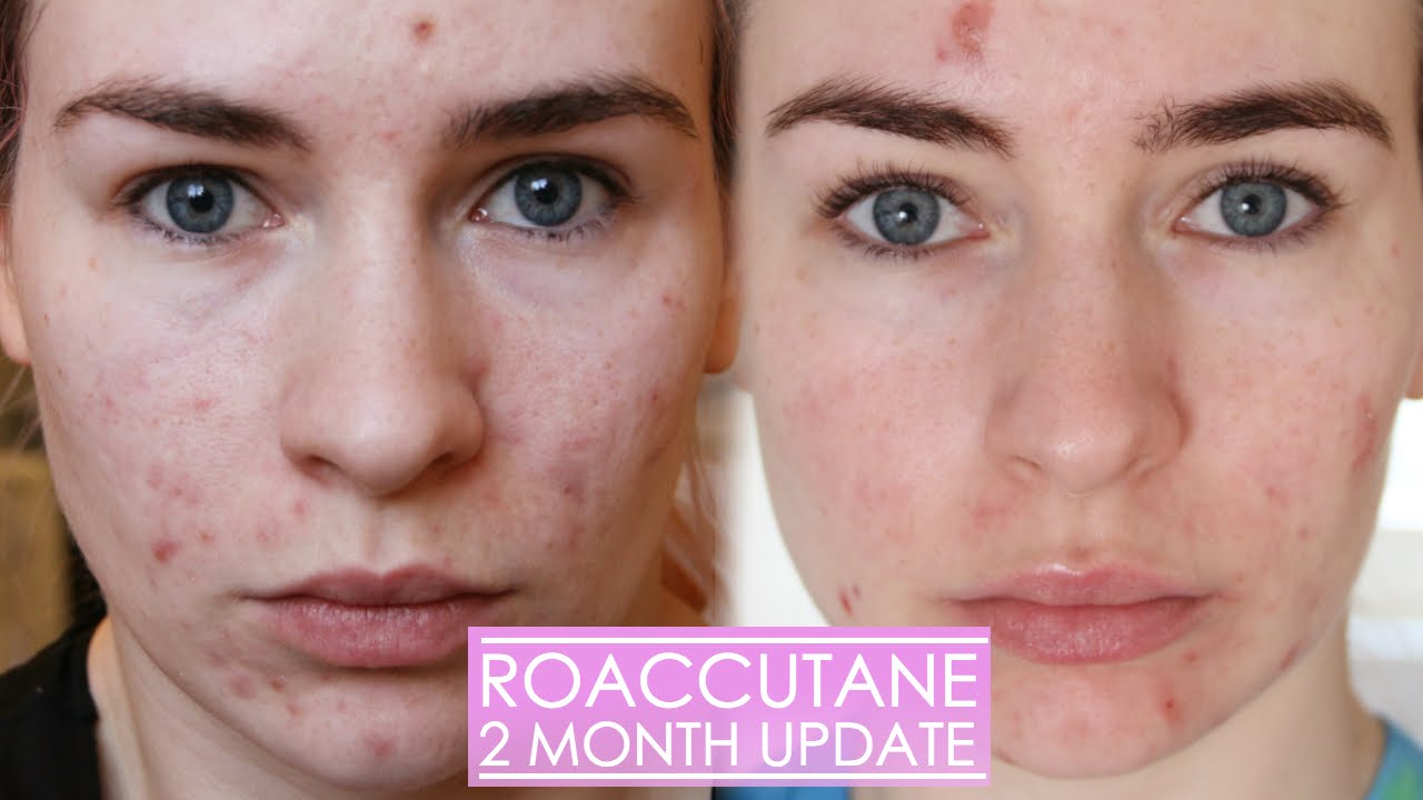 Roaccutane 20mg online