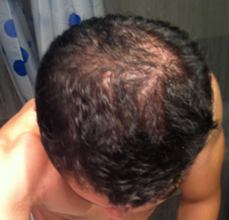Finasteride 1 Mg Pharmacie En Ligne