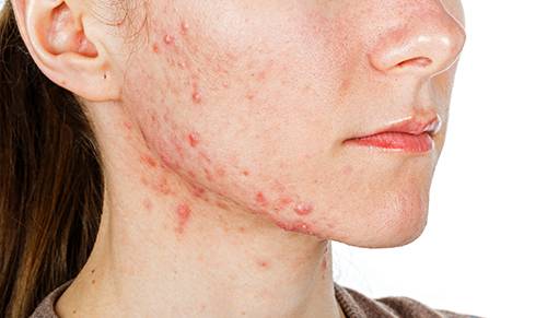 pilule apres roaccutane