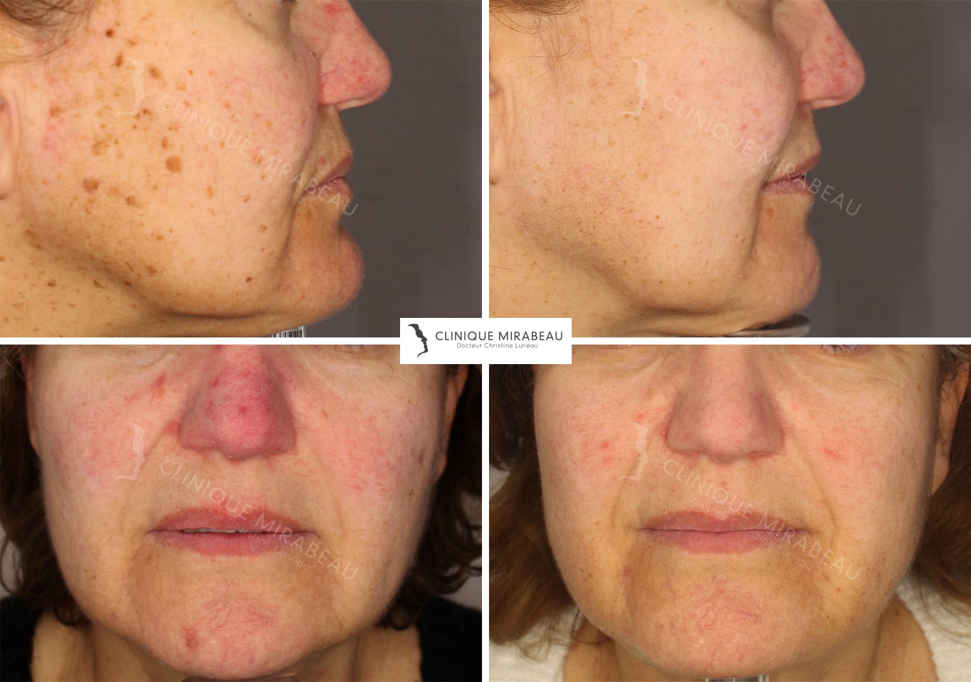 prix du roaccutane