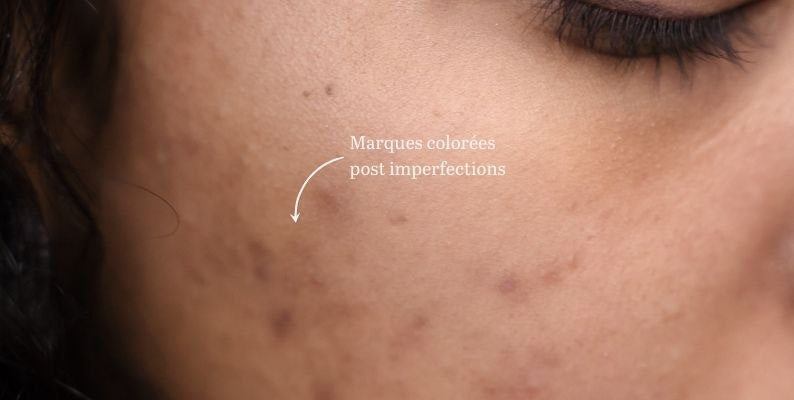 roaccutane arret pilule