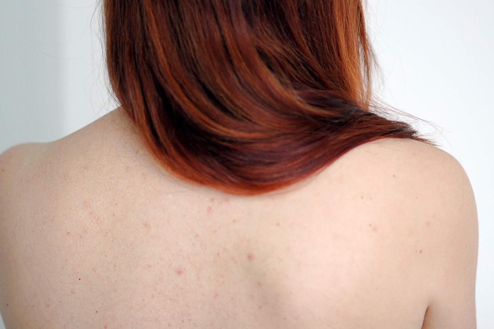 roaccutane acné pilule