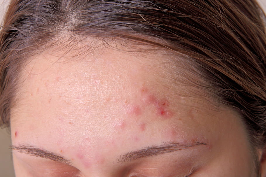 Roaccutane Quelle Pilule