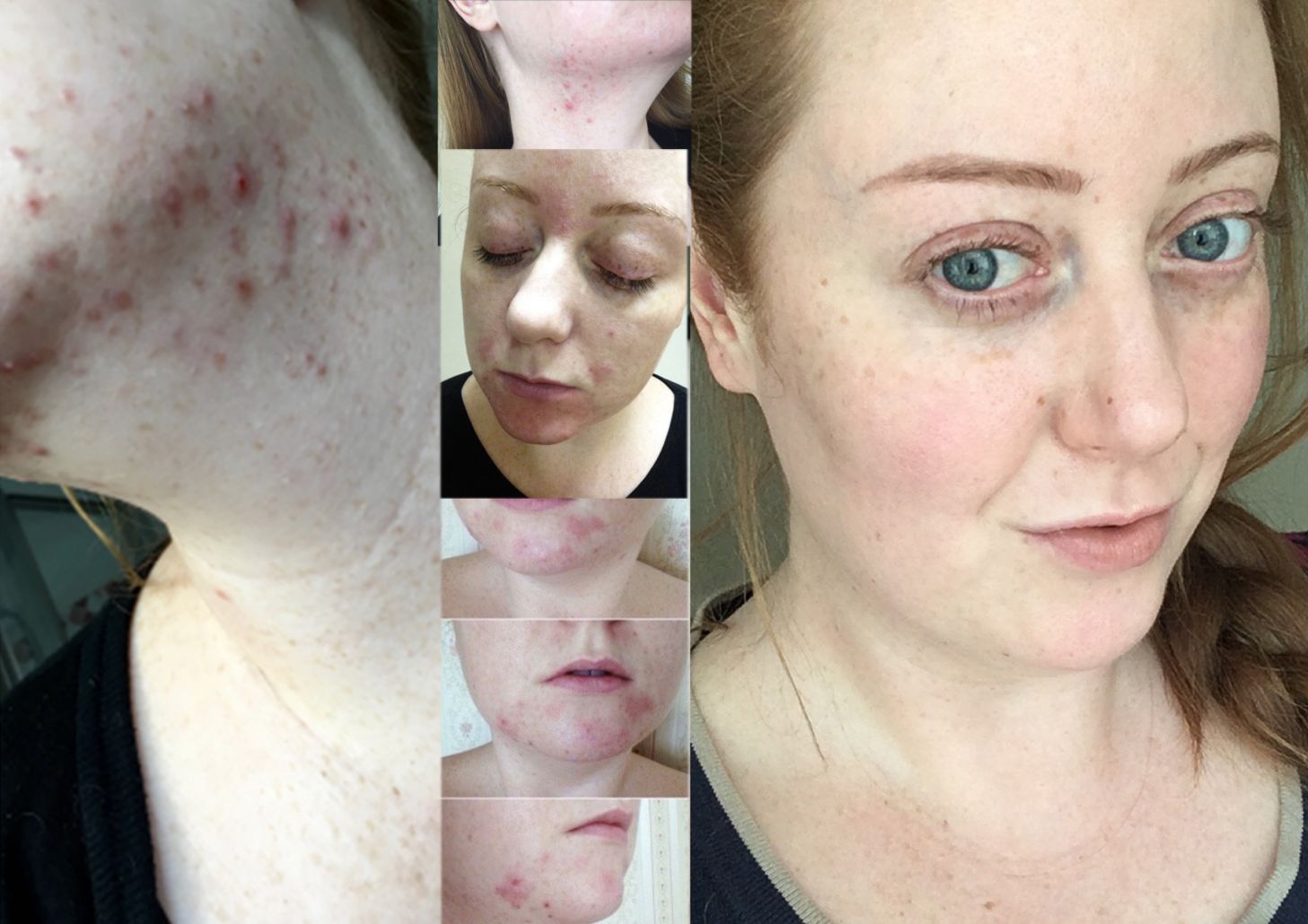 commander accutane