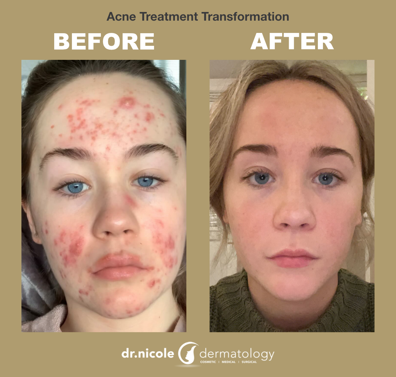 Online dermatologist isotretinoin