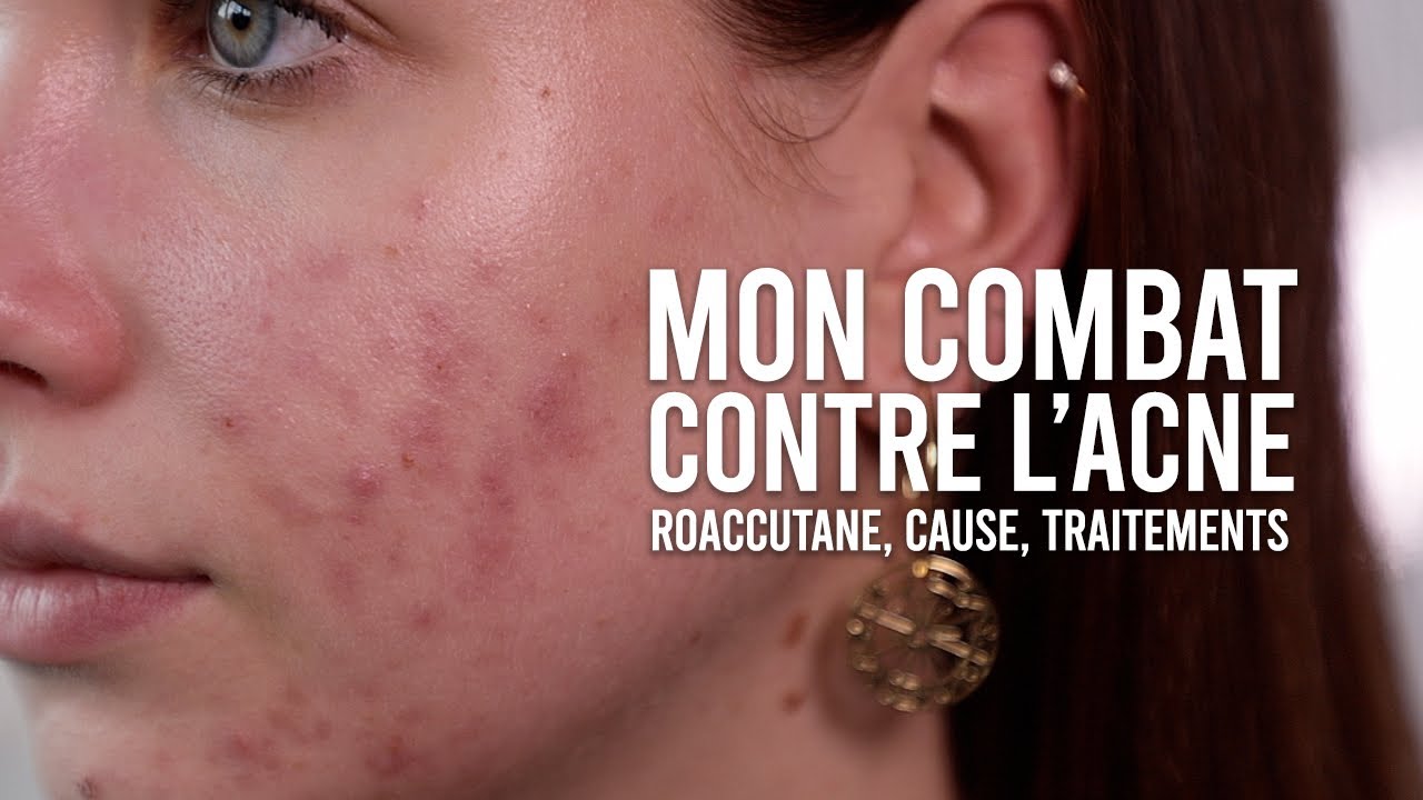 Roaccutane avec pilule