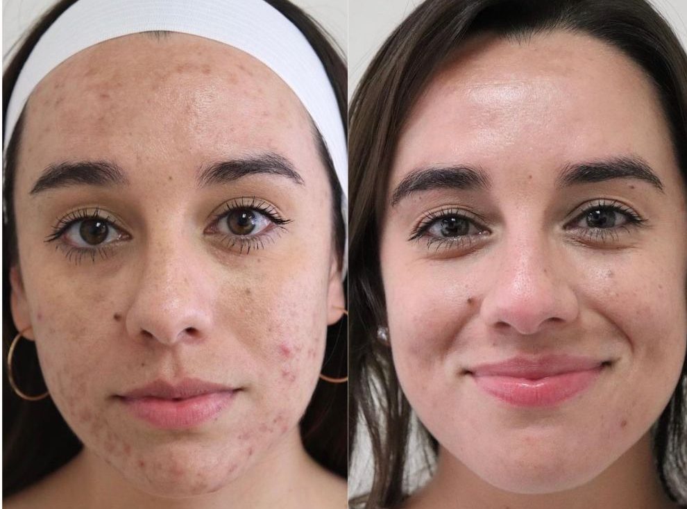 Accutane 40mg