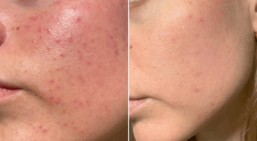 accutane comment acheter