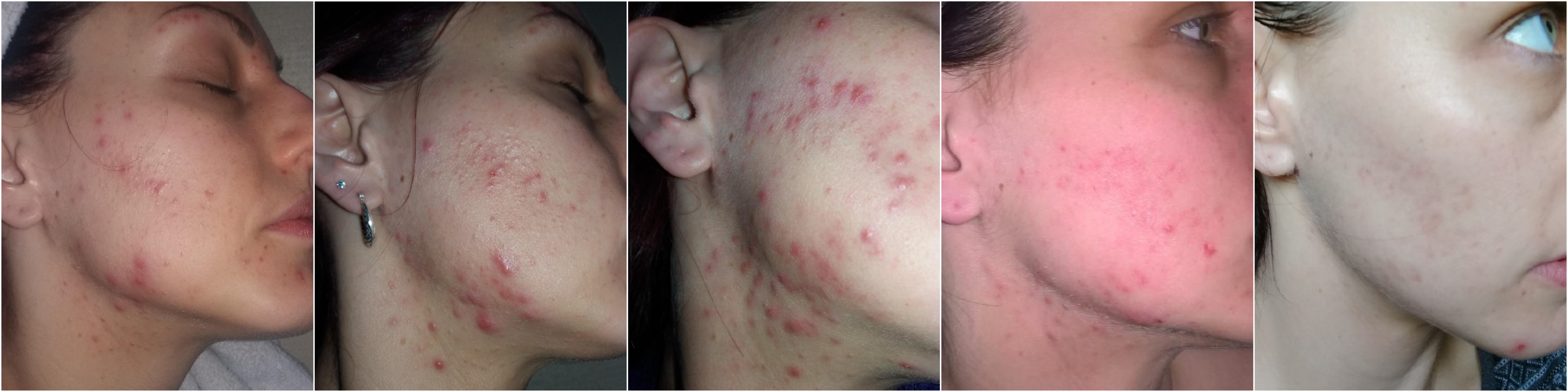 accutane online italia