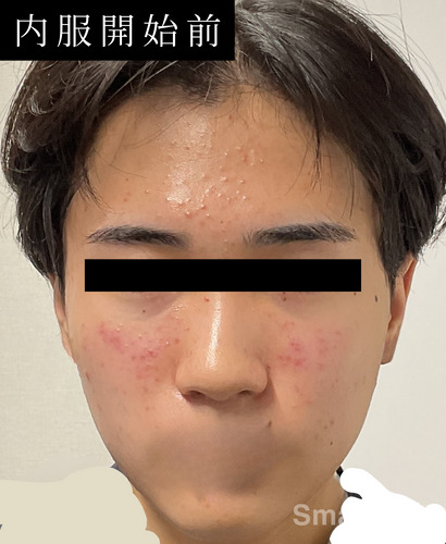Accutane sans ordonnance
