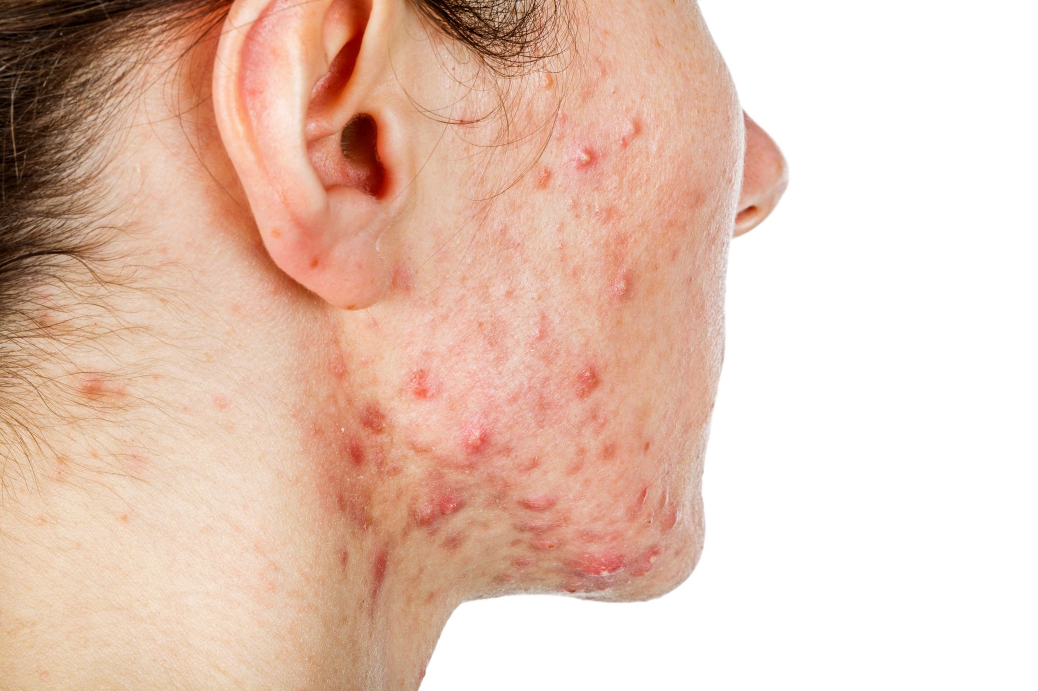 Acheter isotretinoin
