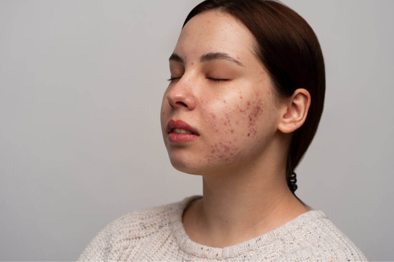 Online dermatologist accutane