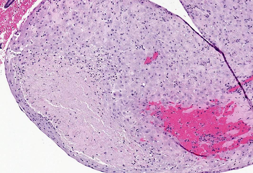 clomiphene pilules
