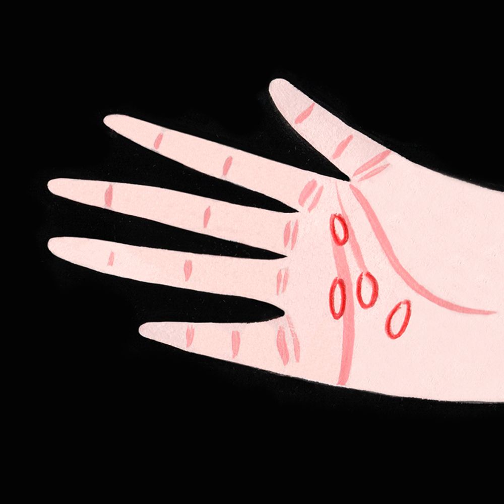 Commander Isotretinoin