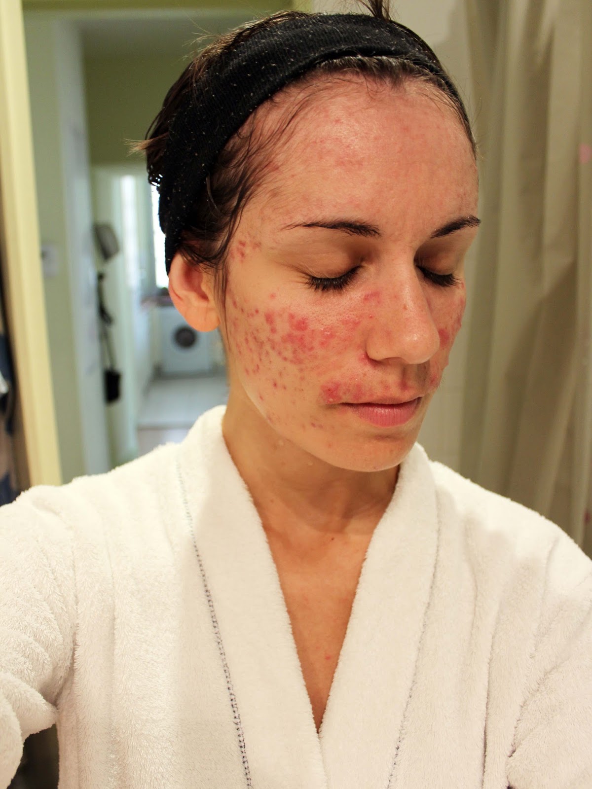 Coût Roaccutane