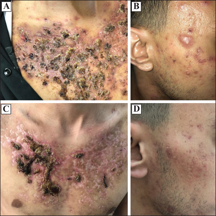comment acheter du isotretinoin