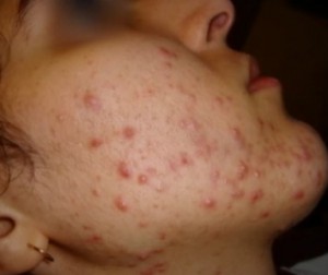 Avoir Roaccutane Sans Ordonnance