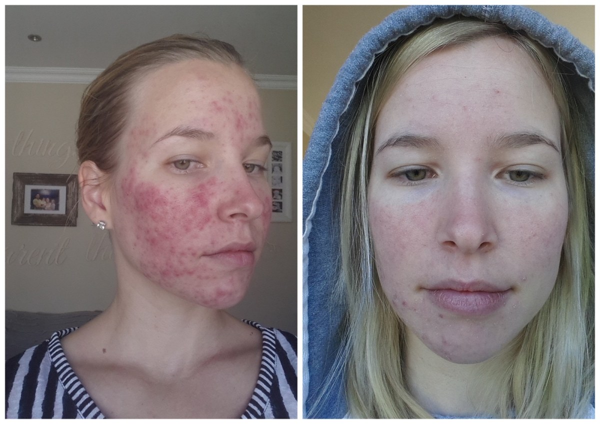 Roaccutane pas cher