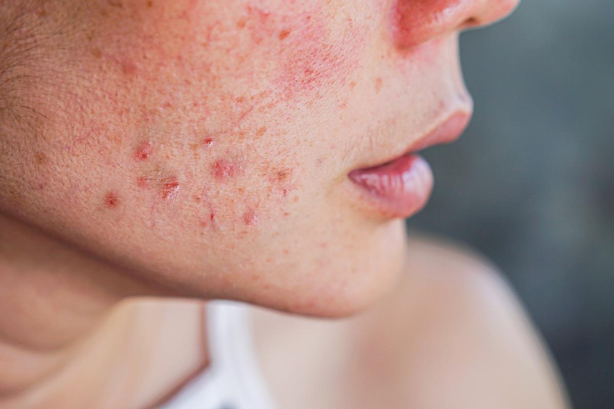 Commander Roaccutane En Ligne