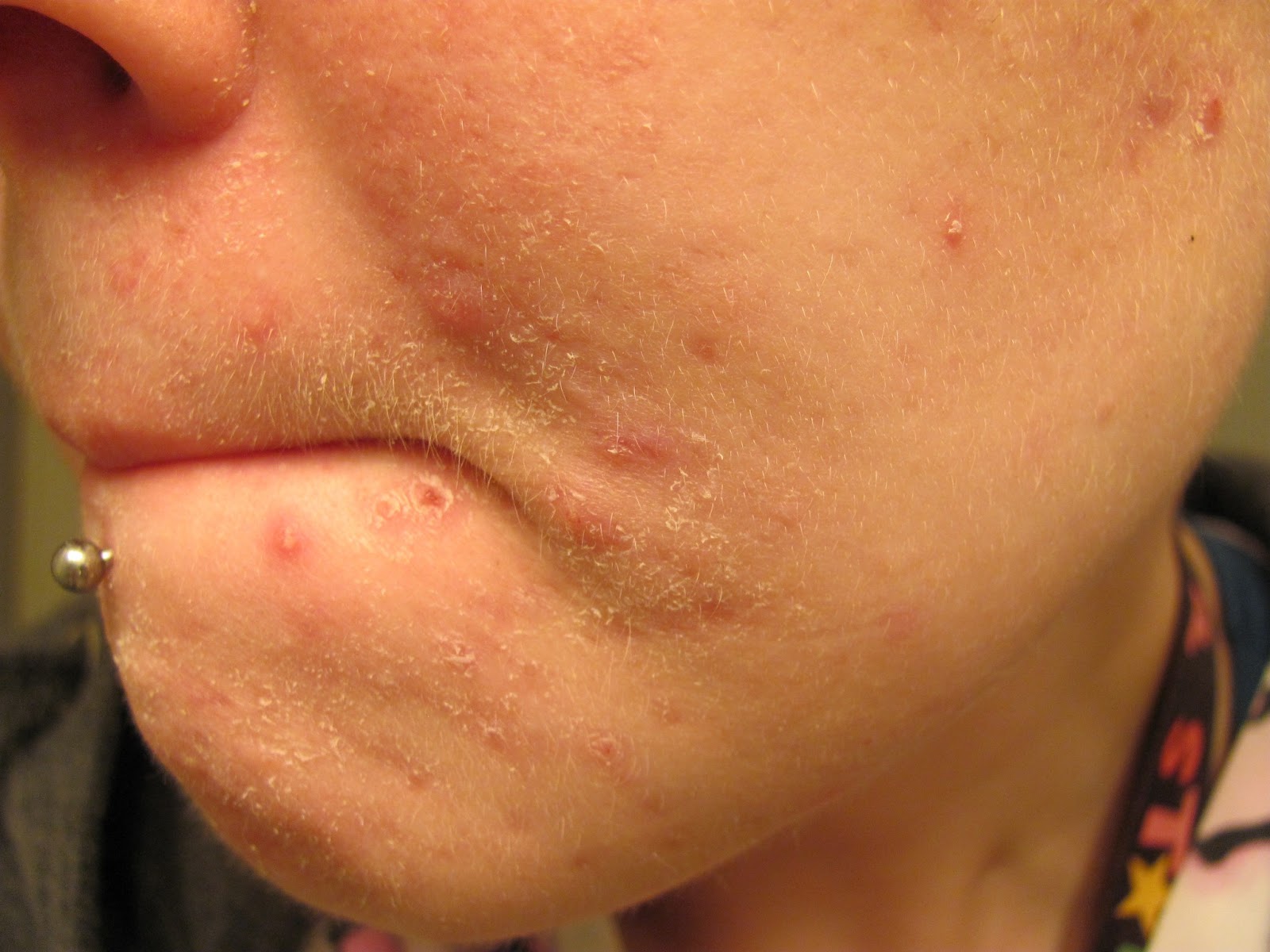 accutane 30mg online