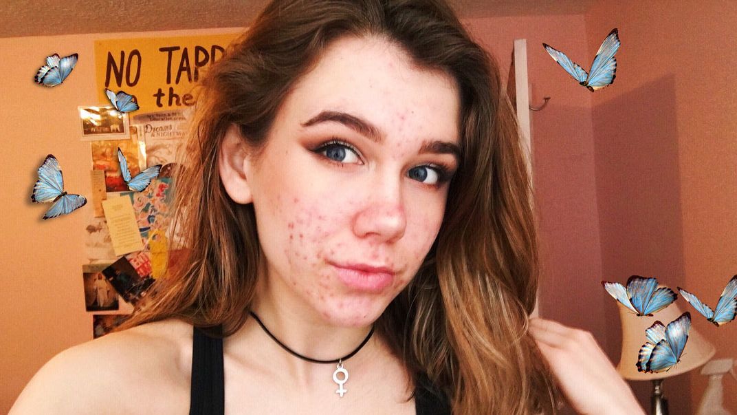 Doxycycline Acne Online