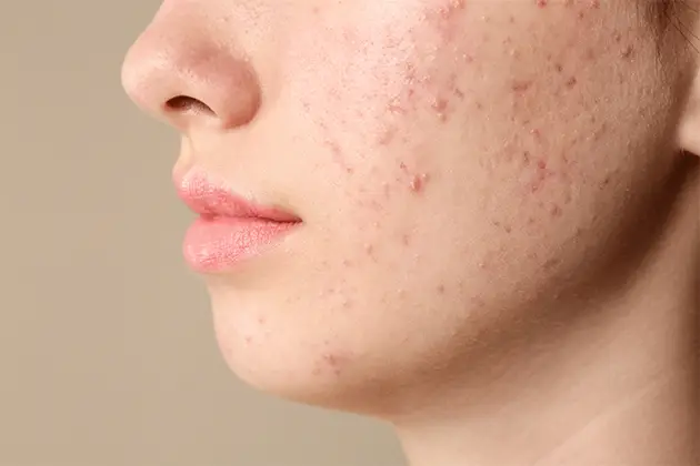Roaccutane achat en ligne