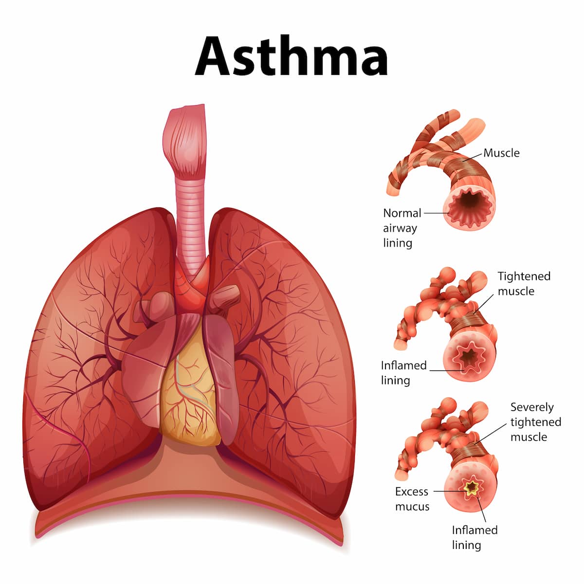 Albuterol pilule