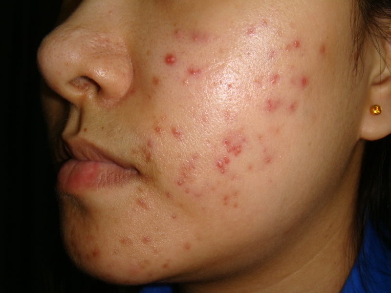 Accutane 40mg Online