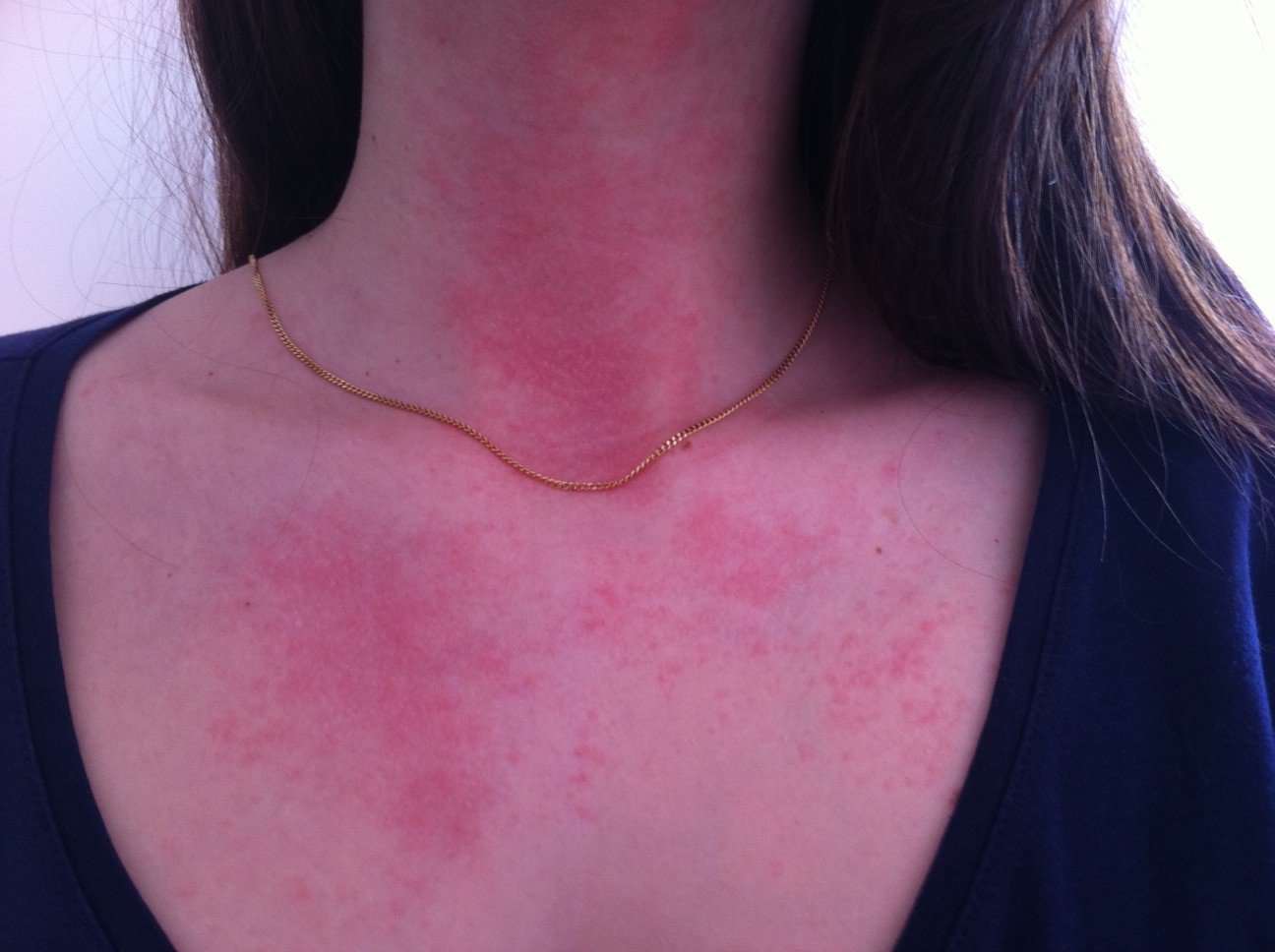 Roaccutane cachet prix