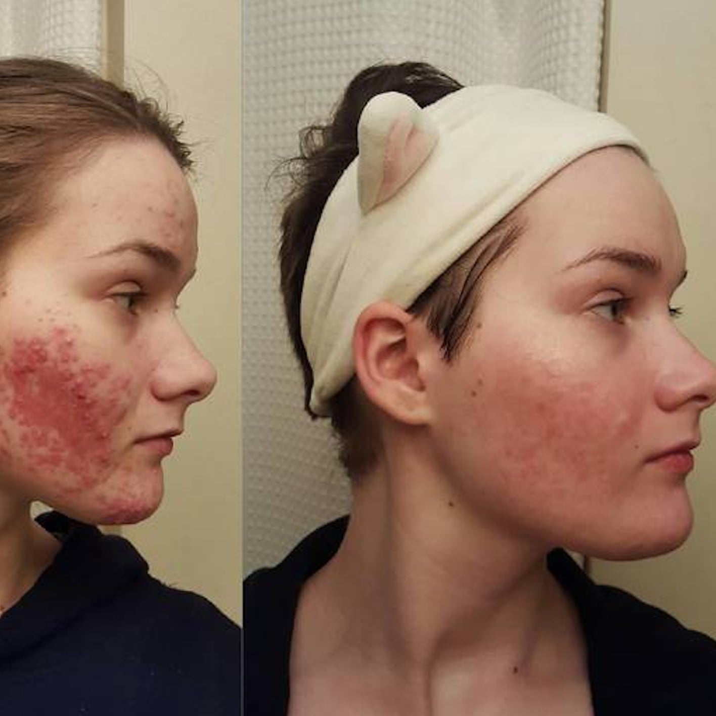 Isotretinoin 20mg online