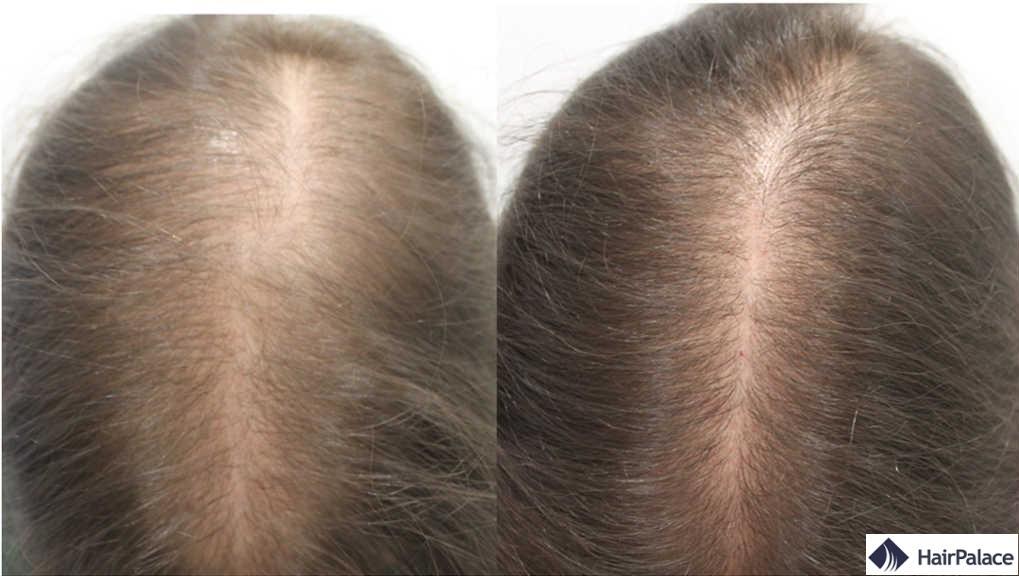 Ou Acheter Finasteride Gel