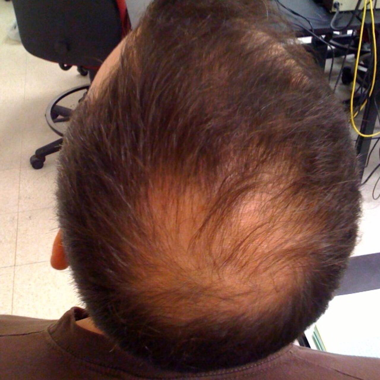 Finasteride en france