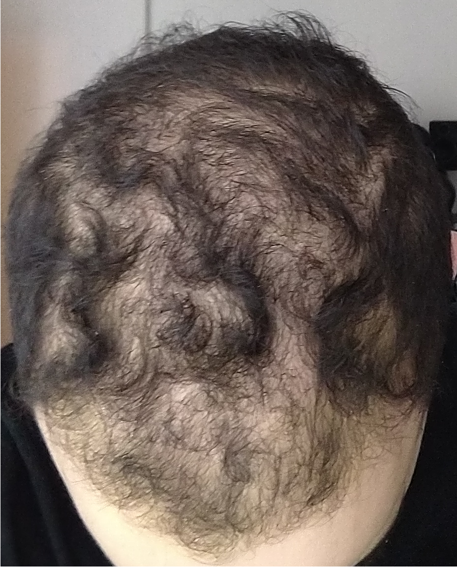 finasteride gel online