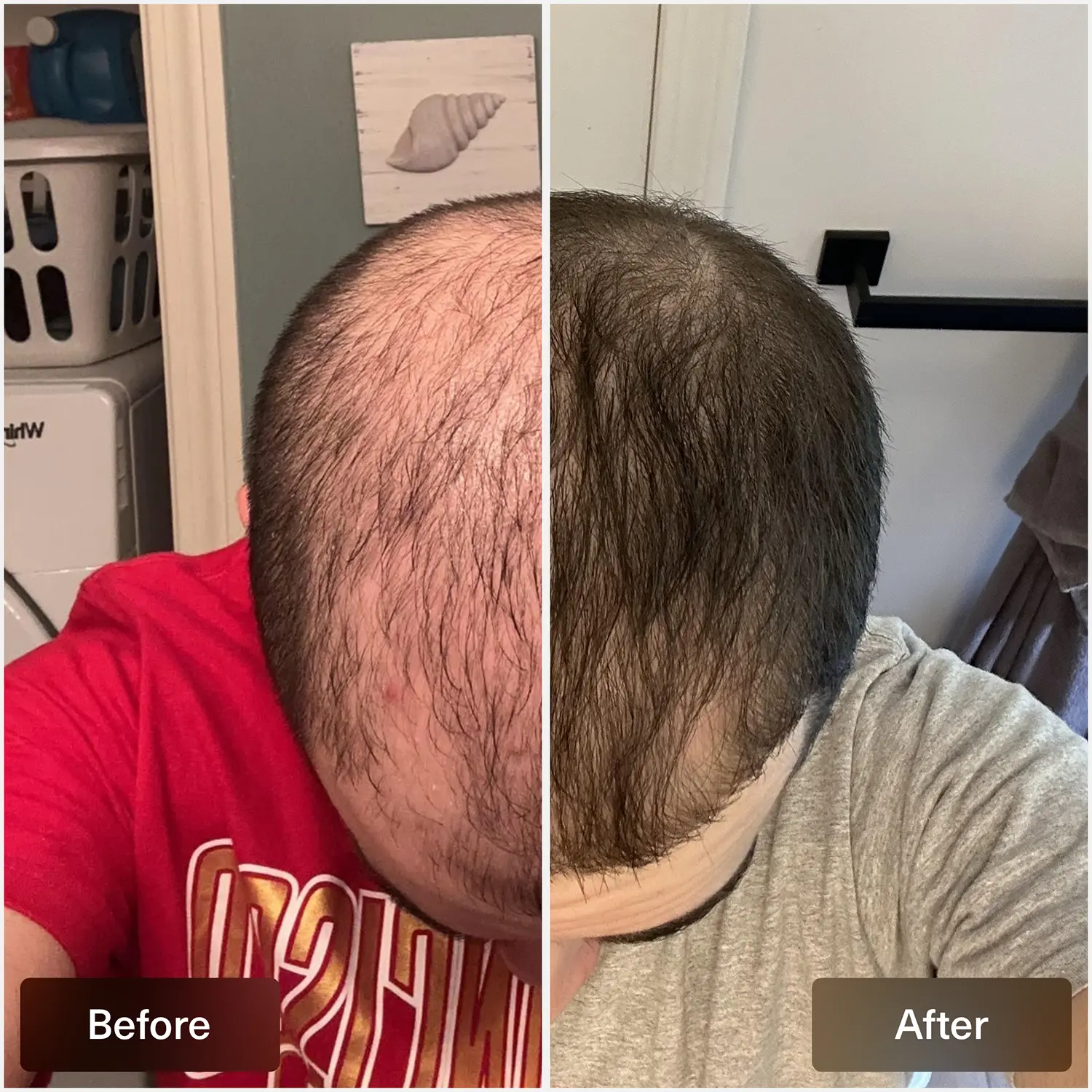 Finasteride Gel Online