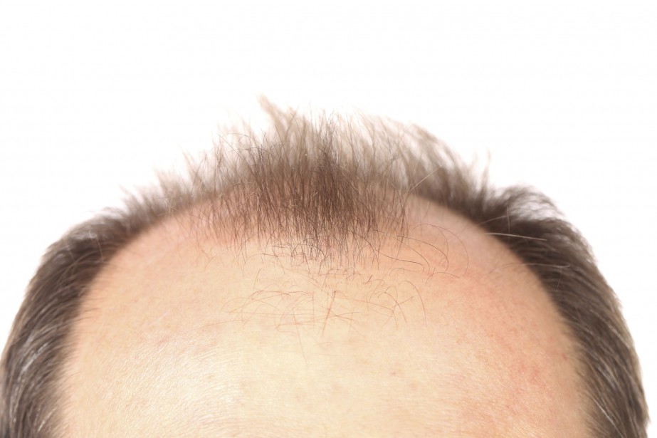 finasteride in france