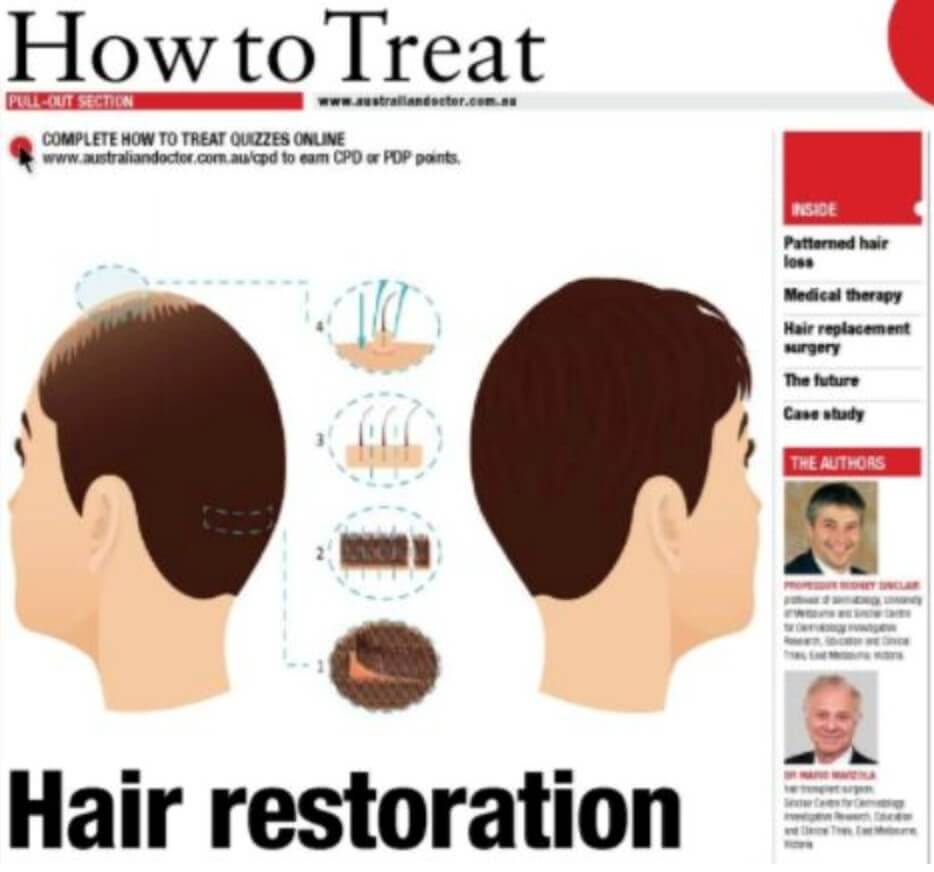 finasteride normon online