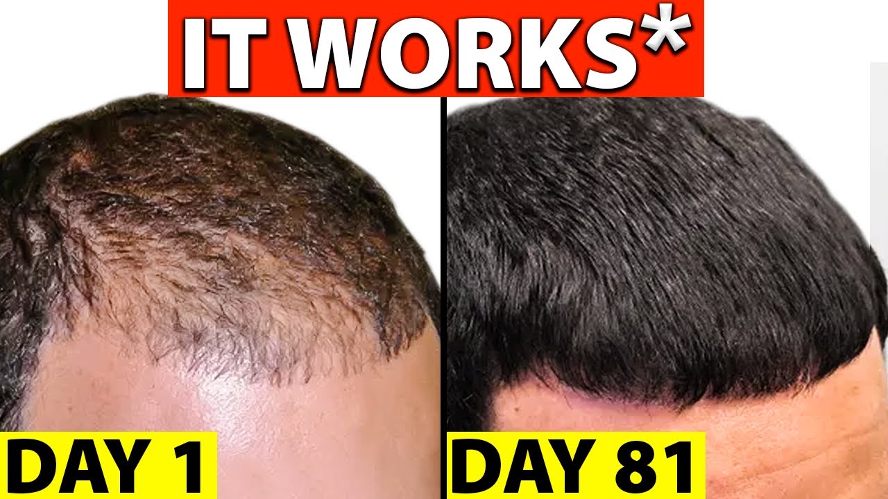 finasteride normon online