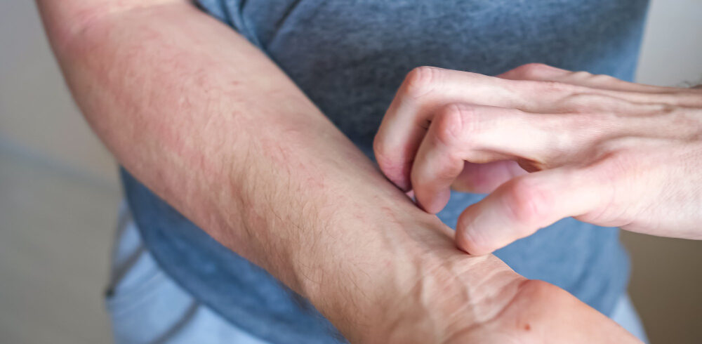 Isotretinoin pilule