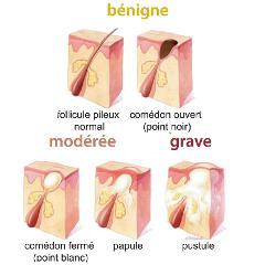 isotrétinoïne bon marché