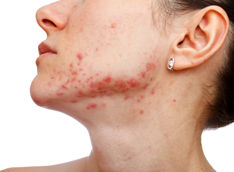 ordre accutane