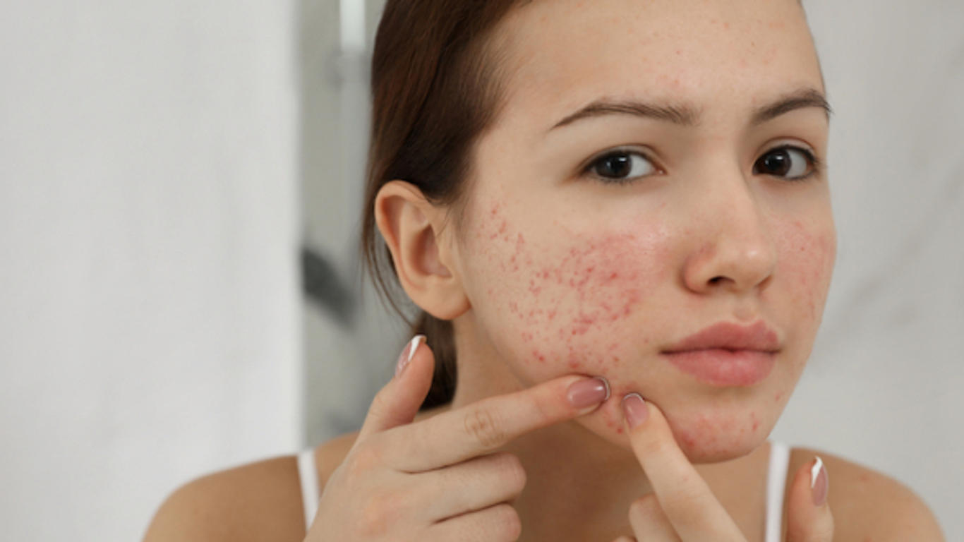 Ordre Roaccutane
