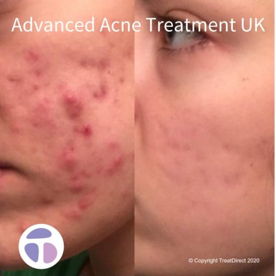 Ordre roaccutane