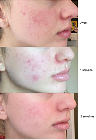 Ou Acheter Du Roaccutane