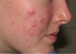 Pilule optilova roaccutane