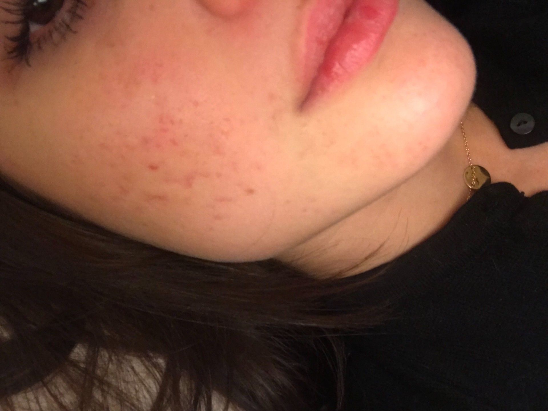 Prix Pour Roaccutane