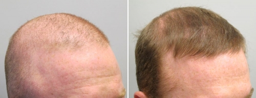 Propecia cheveux prix