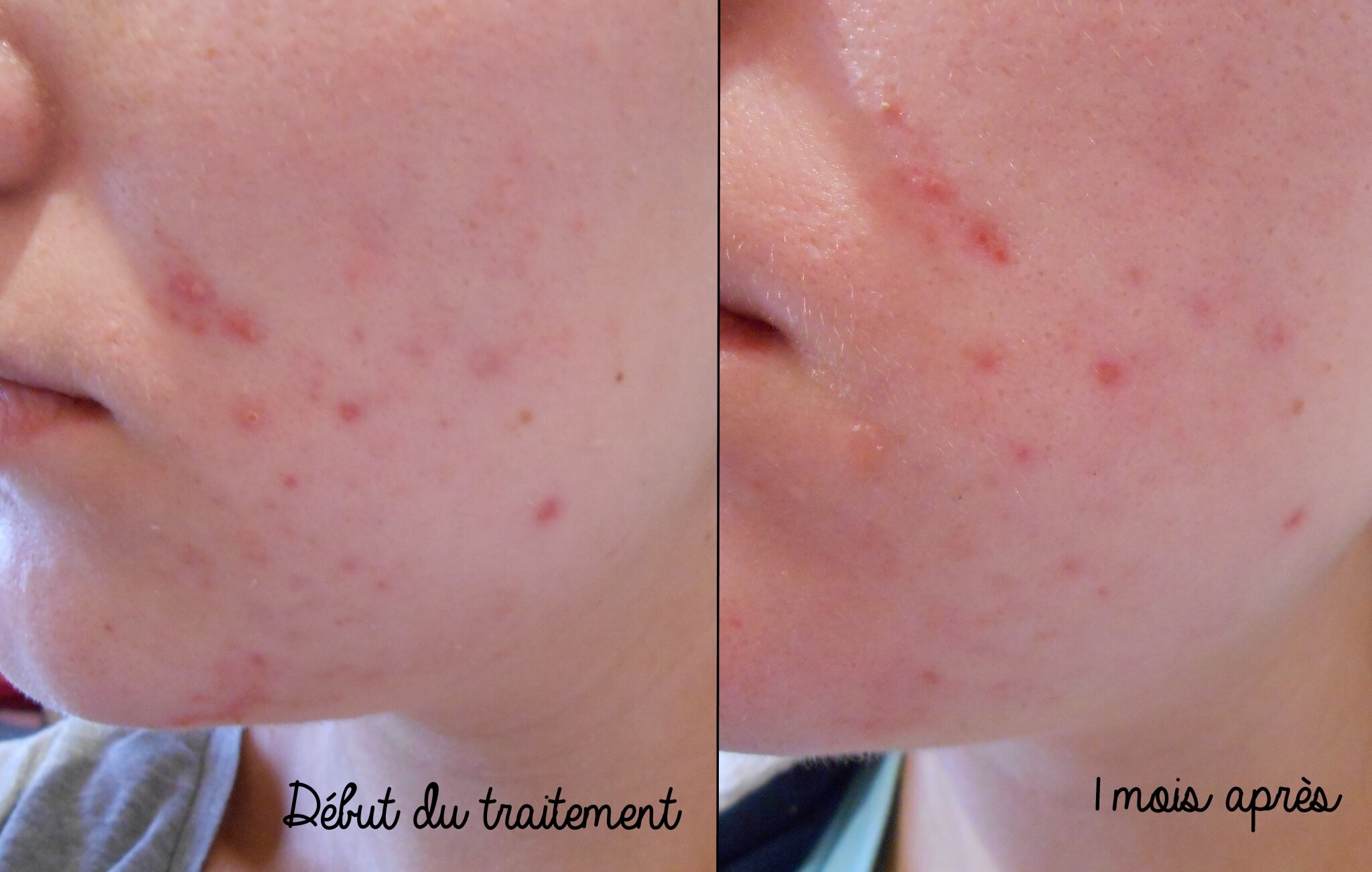 Roaccutane 20mg