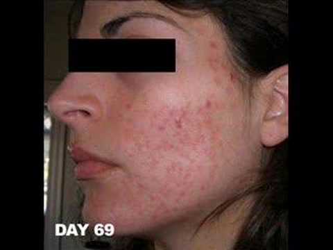 Roaccutane 20mg online